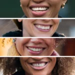 Crafting Smiles with Minimal Intervention: The Composite Bonding Advantage