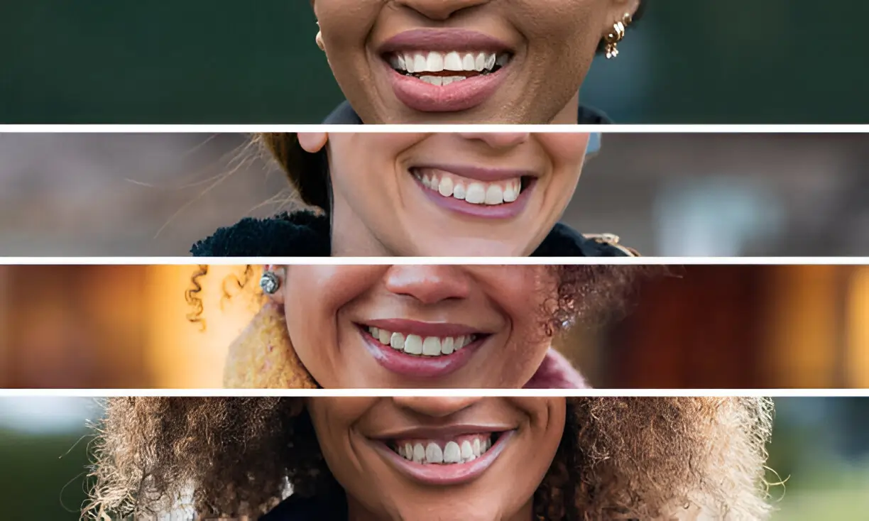 Crafting Smiles with Minimal Intervention: The Composite Bonding Advantage