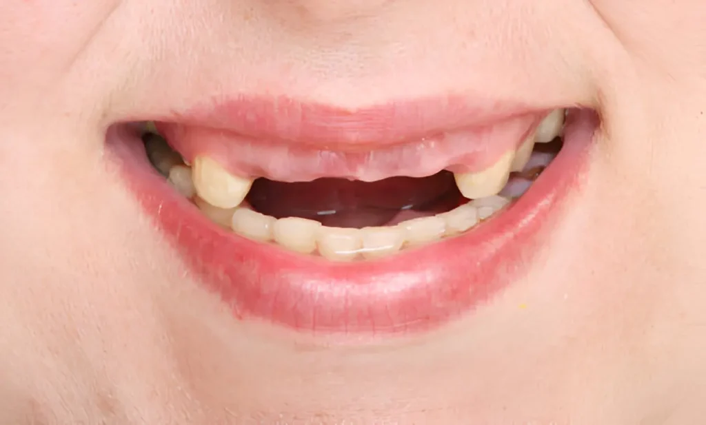 Missing Teeth How It Impacts Your Health and Confidence